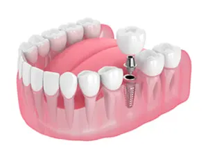 model of dental implant