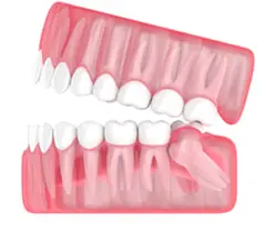 model of impacted wisdom tooth